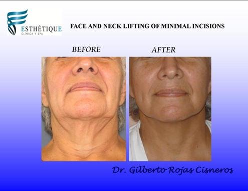 Face and Neck Lift Before After